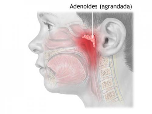 Как избавиться от аденоидов у ребенка народными средствами. Лечение аденоидов у детей — рецепты народных средств