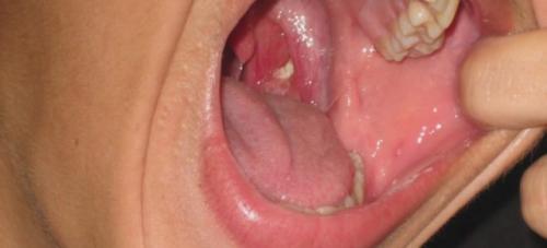 Как чистят миндалины от гнойных пробок. Чистка миндалин от пробок