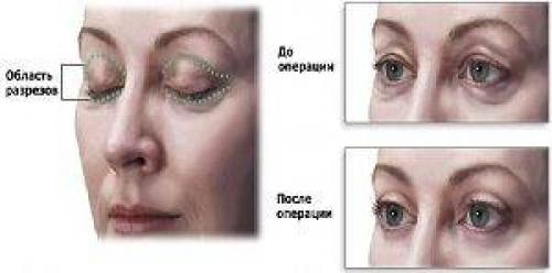 Под глазами темные круги, как избавиться. Как от них избавиться? 08