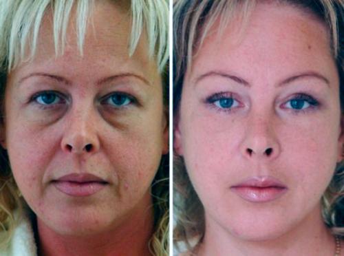 Под глазами темные круги, как избавиться. Как от них избавиться?