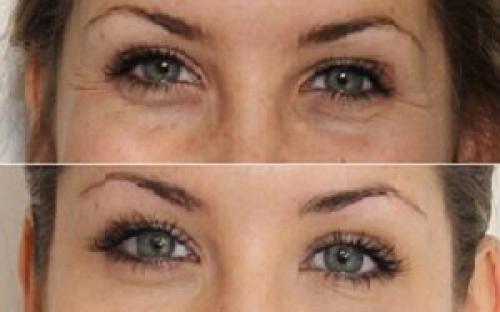 Под глазами темные круги, как избавиться. Как от них избавиться? 06