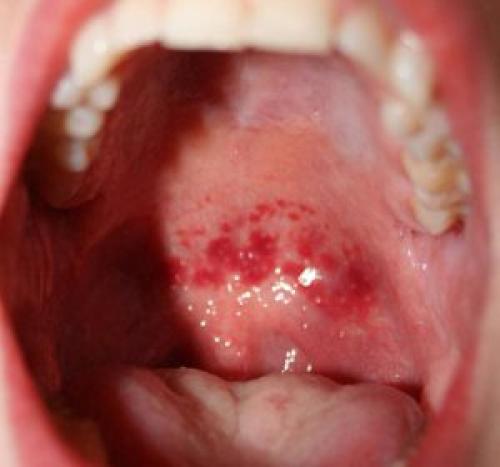 Черная точка на щеке внутри. Черная точка во рту на щеке, как родинка 07