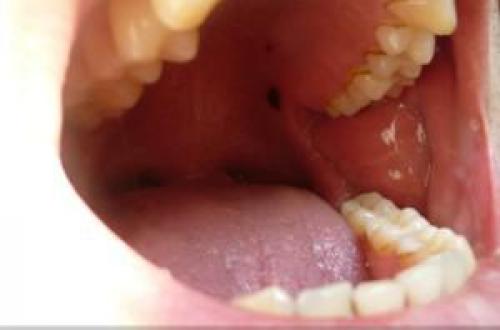 Черная точка на щеке внутри. Черная точка во рту на щеке, как родинка 01