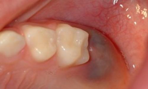 Черная точка на щеке внутри. Черная точка во рту на щеке, как родинка 06