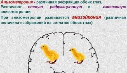 Разница в диоптриях между глазами. Анизометропия