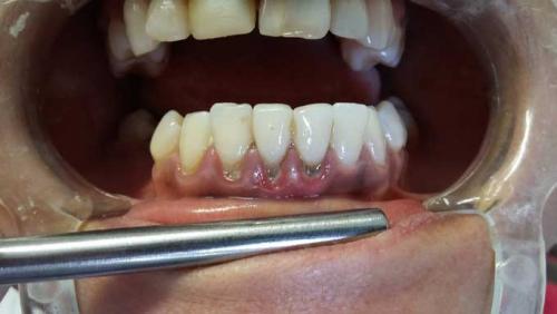 Черная точка на щеке внутри. Черная точка во рту на щеке, как родинка 03