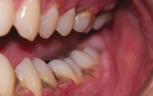 Черная точка на щеке внутри. Черная точка во рту на щеке, как родинка 04