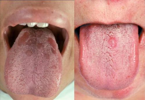 Черная точка на щеке внутри. Черная точка во рту на щеке, как родинка 08