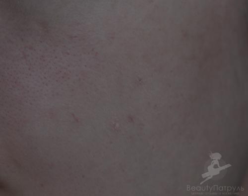 Зеленый корректор для лица, как пользоваться. Зеленый консилер для лица – идеальное средство маскировки недостатков кожи 26