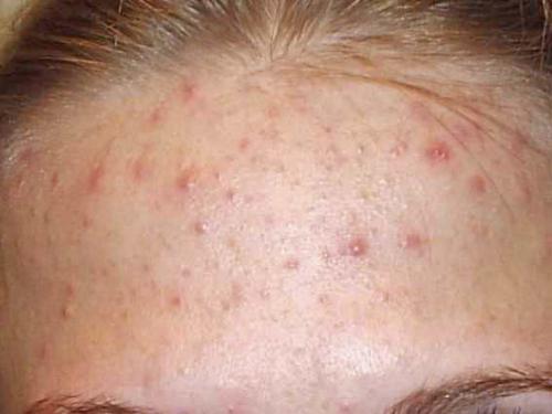 Скраб для лица от прыщей в домашних условиях. Как сделать дома 02 Скраб для лица от прыщей в домашних условиях. Как сделать дома 02