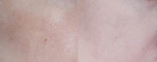 Камуфляж пигментных пятен. Маскировка пигментных пятен после 50 лет: простая техника на каждый день (фото до и после)