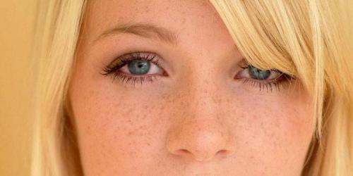 Как убрать пигментные пятна на лице. Причины появления пигментных пятен на лице
