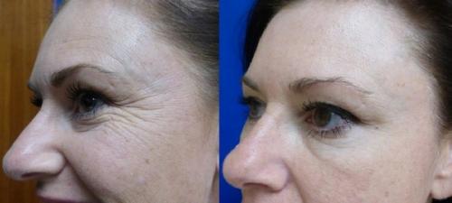 Народные средства от морщин на лбу. Как эффективно избавиться от морщин на лбу?