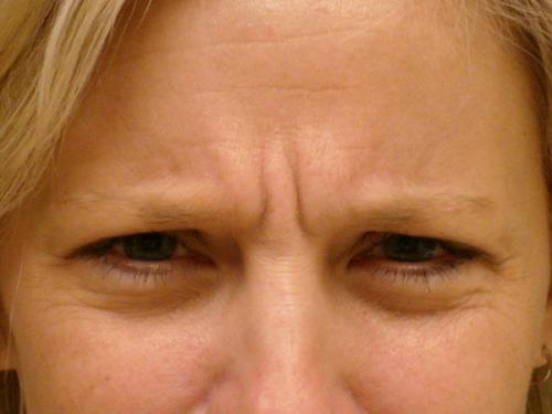 Народные средства от морщин на лбу. Как эффективно избавиться от морщин на лбу?