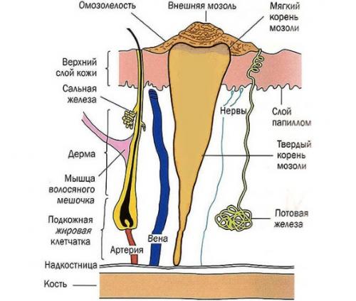 Стержневая мозоль на пальце ноги. Стержневая мозоль