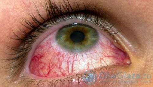 Снять отек с глаз быстро после слез. Быстро снять отек с глаз после слез 13