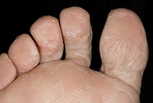 Между пальцами ног облазит кожа и запах. Почему слезает кожа с пальцев?