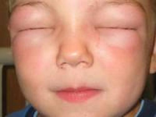 Красный цвет лица. Физиологические причины