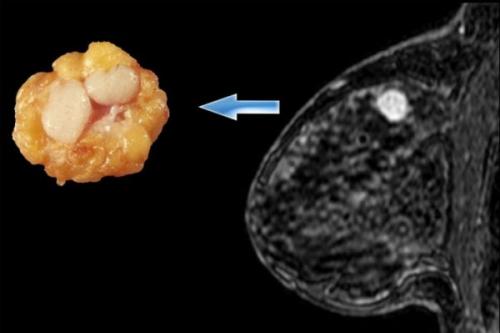 Фиброзная мастопатия лекарства. Каким должно быть лечение фиброзно-кистозной мастопатии: обзор эффективных средств и отзывы женщин