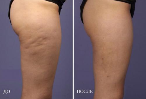 Антицеллюлитное обертывание с кофе. Как делать процедуру в домашних условиях