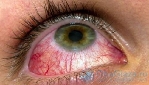 Глаза опухли от слез, как снять отек. Что делать, если опухли глаза от слез, как убрать заплаканные веки и снять отек