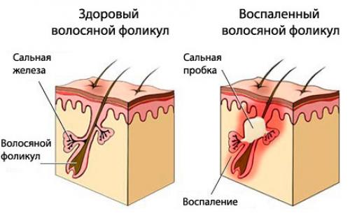Сухая кожа стала жирной. Причины жирной кожи