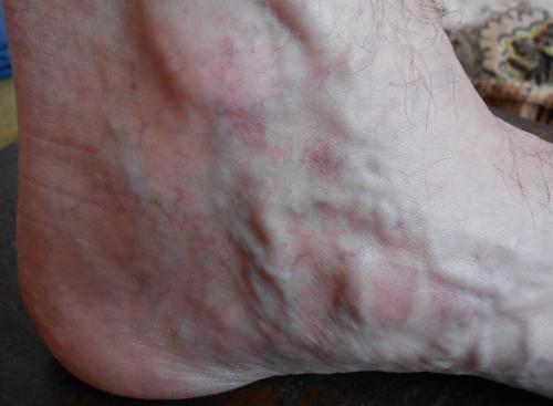 Средство от запущенного варикоза. Что делать с запущенным варикозом?