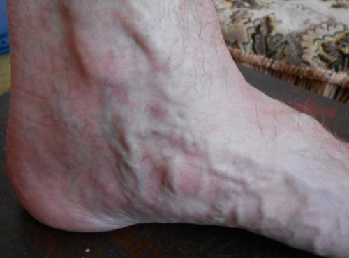 Средство от запущенного варикоза. Что делать с запущенным варикозом?