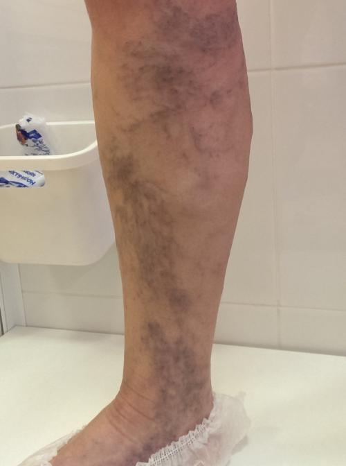 Средство от запущенного варикоза. Что делать с запущенным варикозом?