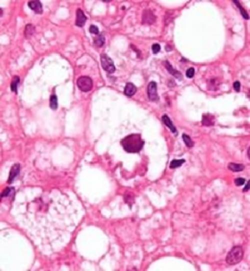 Как лечить ожирение печени. Лечение 04 Как лечить ожирение печени. Лечение 04