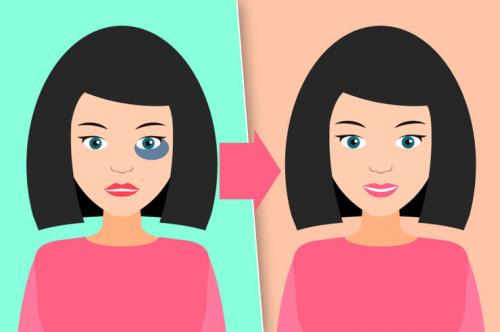 Убрать синяк за 1 день. Скорая помощь: как быстро убрать синяк