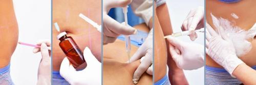 Возвращается ли жир после липолитиков. Липолитики, спасение или непоправимый вред