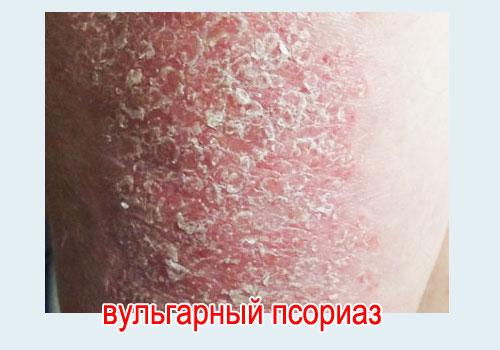 Псориаз: виды, лечение, советы врача
