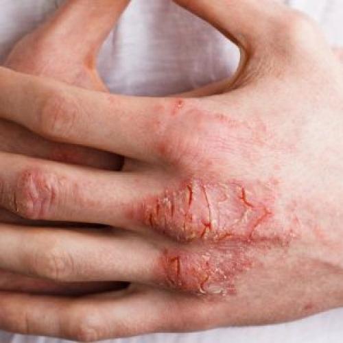 Шелушение кожи на руках. Причины