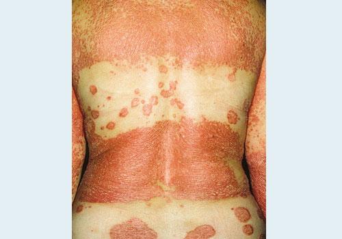 Псориаз: виды, лечение, советы врача