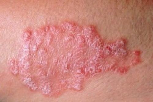 Дерматит. Симптомы дерматита, причины и лечение у взрослых