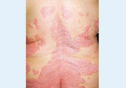 Псориаз: виды, лечение, советы врача