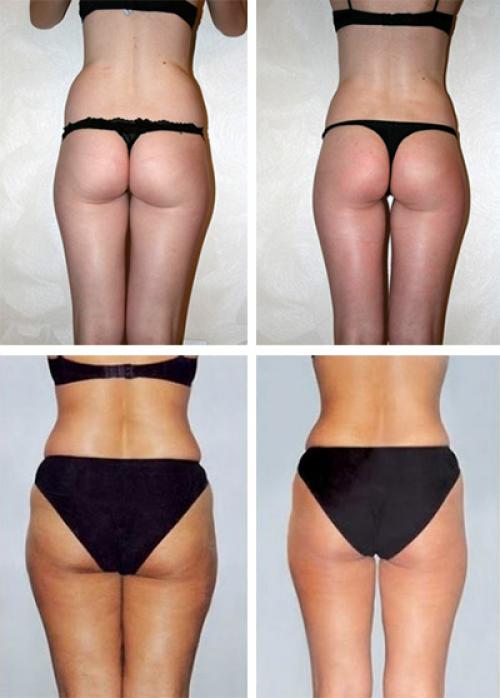 Горчичные обертывания для похудения. Почему горчица работает для похудения 03 Горчичные обертывания для похудения. Почему горчица работает для похудения 03