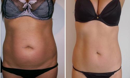 Как похудеть на 10 кг за 2 недели? Вы успеете стать худой к лету, если начнете прямо сейчас!