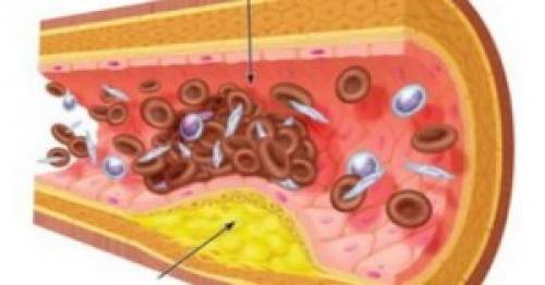 Чем плох лишний вес. Лишние проблемы от лишнего веса