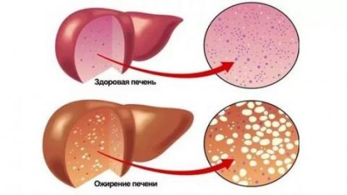 Как убрать жировые отложения в печени. Причины отложения жира в печени