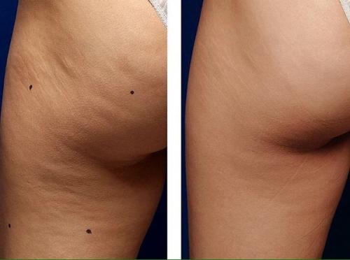 Аппарат для похудения lpg. LPG массаж: описание процедуры