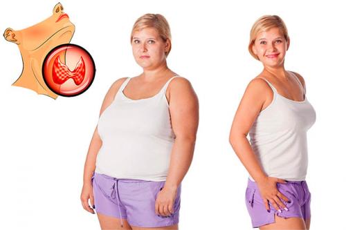 Похудение и гипотиреоз. Гипотиреоз и лишний вес