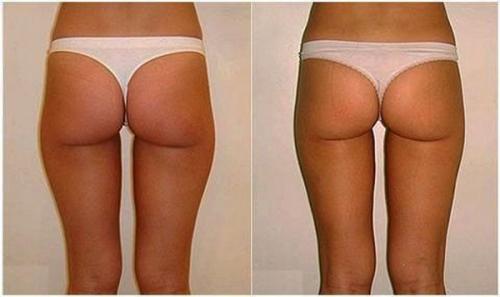 Аппарат для похудения lpg. LPG массаж: описание процедуры