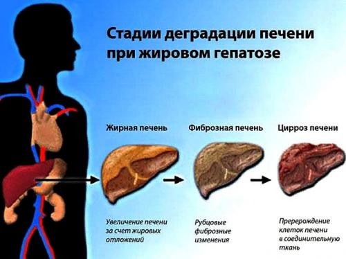 Можно ли вылечить жировой гепатоз печени. История о том, как пациент излечился от жирового гепатоза печени