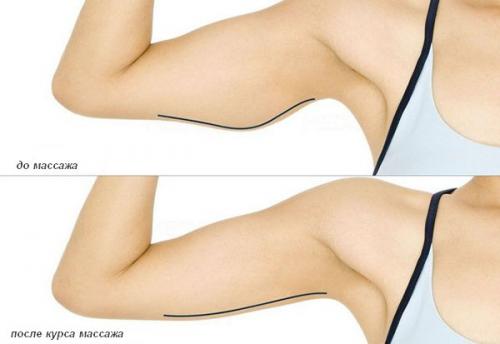 Самомассаж для похудения рук. Техника проведения локального массажа