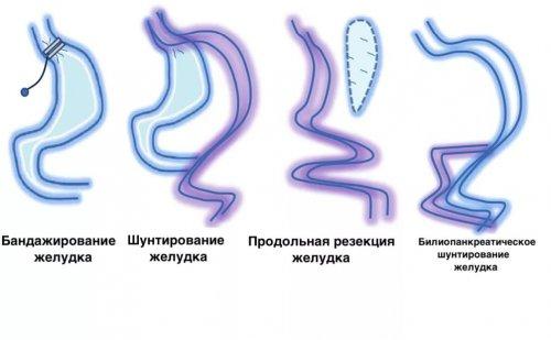 Шунтирование желудка показания. Что такое шунтирование