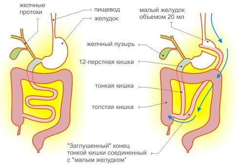 Шунтирование желудка показания. Что такое шунтирование