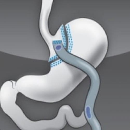Шунтирование желудка или резекция. Шунтирование желудка