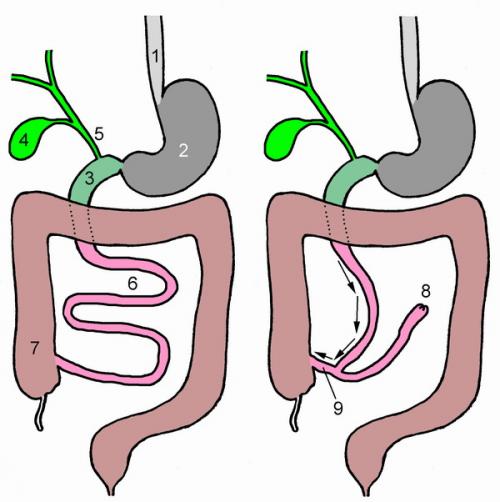 Шунтирование желудка показания. Желудочное шунтирование — показания к операции, этапы шунтирования желудка